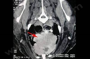Scanner thoracique du médiastin d’un chien de race Labrador atteint d’un thymome