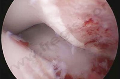 Image d’arthroscopie d’un coude présentant des lésions d’ostéocondrite dissécante