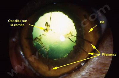 Persistance de membrane pupillaire chez un chien Griffon vendéen. Des filaments pigmentés partent de l’iris et rejoignent la face postérieure de la cornée en son centre.