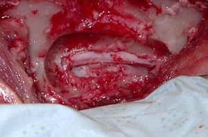 Chirurgie après retrait d'une hernie discale aiguë