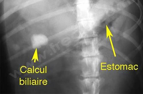 Centre Hospitalier Vétérinaire Fregis, Radiographie d’un chien présentant un volumineux calcul dans la vésicule biliaire