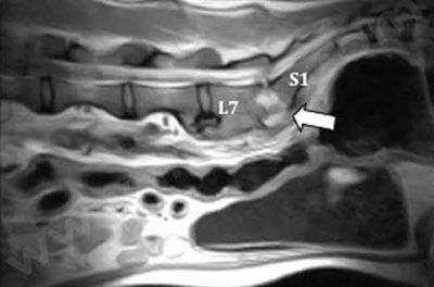 Résonance magnétique mettant en évidence une infection entre deux vertèbres (flèche), sur un chien atteint d'une endocardite