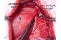 3. Chirurgie chez un chien souffrant d’une persistance du 4ème arc aortique. Le vaisseaux anormal provoque la striction de l’œsophage qui apparaît très dilaté (jabot œsophagien).