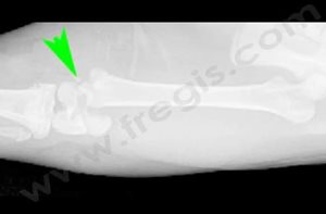 Radiographie d’une fracture du cartilage de croissance du fémur distal (Salter Harris 1)