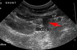 1. Echographie abdominale d’un chien atteint d’un shunt portosystémique (VP : veine porte, VCC : veine cave caudale)