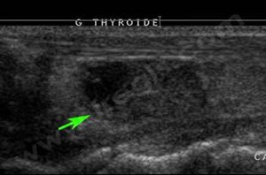 2. Echographie de la thyroïde d’un chat souffrant d’hyperthyroïdie