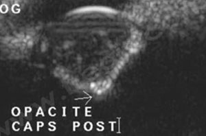 1. Cataracte congénitale évoluée chez un Cavalier King Charles Spaniel de 6 ans. L’échographie révèle la déformation conique de la face postérieure du cristallin dans le vitré (flèche blanche). Sur cette image, la partie antérieure de l’œil (cornée) est en haut de l’image, et la partie postérieure (fond d’œil) en bas de l’image. La flèche noire indique la face antérieure du cristallin