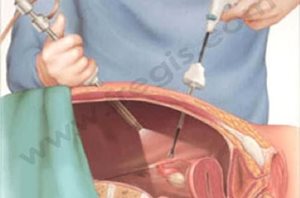 Schéma montrant le principe de la laparoscopie