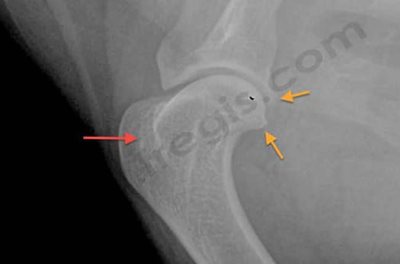 Images radiographiques. Vues latérales des épaules gauche et droite d’un Berger Allemand de 11 ans présentant une ténosynovite bicipitale unilatérale droite. Noter les signes d’arthrose de l’épaule, la présence d’ostéophytes (flèches oranges) et une calcification au niveau de la coulisse bicipitale (flèche rouge) du côté droit.