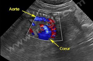 Echographie Doppler couleur en fin de gestation. Le cœur et les gros vaisseaux sont bien visibles
