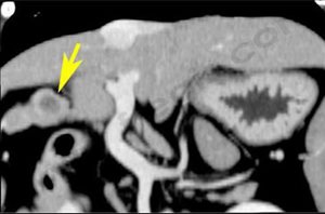 Scanner d’un chien atteint d’un insulinome se présentant sous la forme d’un petit nodule sur le pancréas (flèche)