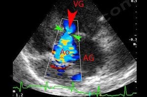 1. Photo 4 : Echocardiographie et Doppler couleur chez un chien Bull terrier avec grave sténose aortique. Le flux sanguin (flèche rouge) entre le ventricule gauche (VG) et l’aorte (Ao) est anormalement étroit au niveau de la sténose (flèches vertes). L’aorte est également très dilatée. (AG : oreillette gauche)