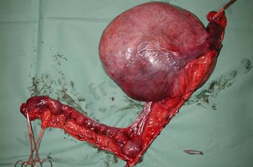 Le pyomètre est une infection grave de l’utérus avec accumulation de pus.