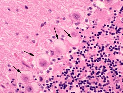 Maladie lysosomale chez un chien (leucodystrophie globoïde) montrant une accumulation anormale de lipides dans certaines cellules du cervelet (flèches). Elles apparaissent très anormalement « gonflées ».