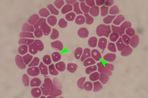 Piroplasmose (babésiose) du chien. Les parasites se trouvent à l’intérieur des globules rouges (flèches vertes)
