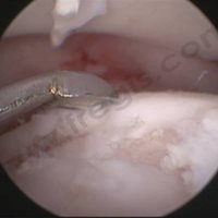 Curetage de l'os situé sous le lambeau de cartilage qui a été retiré. La chirurgie est entièrement réalisée sous arthroscopie.