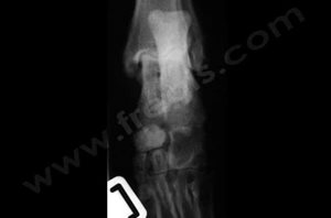 Polyarthrite canine idiopathique, radiographie du tarse​