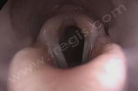 Photo du larynx en position ouvert