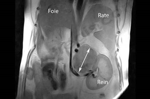 IRM de l’abdomen d’un chien atteint de maladie de Cushing (hypercorticisme) provoquée par une tumeur de la glande surrénale gauche
