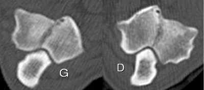 Figure 1 : Images tomodensitométriques des coudes droit et gauche