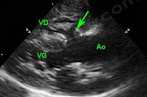 Echographie cardiaque d’un chien atteint d’une tétralogie de Fallot. On note en particulier l’anomalie de position de l’aorte et la communication (flèche) entre les deux ventricules. (VG : ventricule gauche ; Ao : aorte ; VD : ventricule droit)