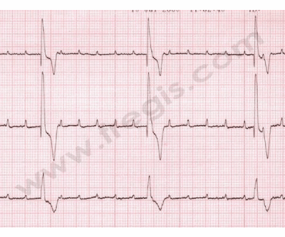 Electrocardiogramme chez un chien montrant une importante bradycardie (due à un bloc atrio-ventriculaire complet).
