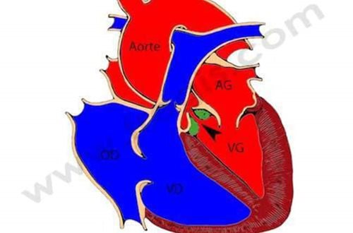 Photo 1 :Sténose aortique chez le chien. Lors de la contraction du cœur, le sang contenu dans le ventricule gauche (VG) a du mal à passer dans l’aorte (flèche), à cause d’un anneau fibreux (en vert) sous la valve aortique. (AG : oreillette gauche ; AD : oreillette droite ; VD : ventricule droit)