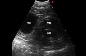 Hernie péricardo-diaphragmatique. L’échographie du thorax montre une vésicule bilaire (VB) anormalement en contact avec le cœur (VD = ventricule droit ; AO : aorte)​