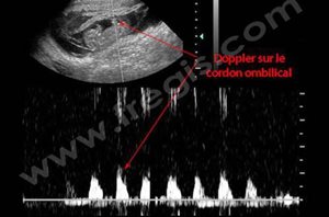 Echographie Doppler pulsé en fin de gestation sur le cordon ombilical