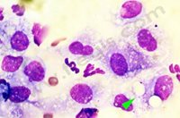 3. Panniculite nodulaire stérile idiopathique du chien : l ‘examen cytologique montre un aspect pyogranulomateux stérile avec macrophage spumeux (remplis de vacuoles graisseuses) (flèche). (© Dr Vét D Héripret)