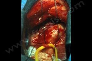 Ligature chirurgicale du canal artériel