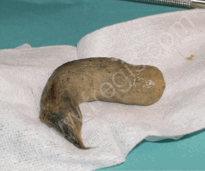 Trichobézoard responsable d’une occlusion intestinale chez un chat et ayant du être retiré par chirurgie.