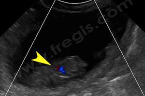 Sur cette gestation de 30 jours, l’activité cardiaque (flèche jaune) est bien visible au Doppler couleur