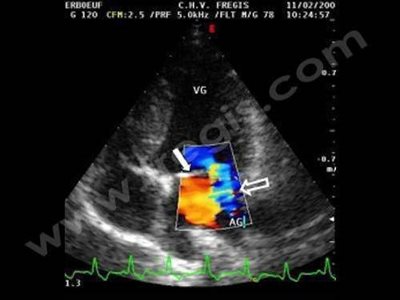 Echocardiographie d’un chien atteint d’endocardiose de la valve mitrale