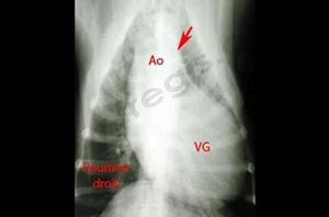 1. Photo 2 : Radiographie du thorax d’un chien Boxer atteint d’une sténose aortique sévère. L’aorte (Ao) est très anormalement dilatée (flèche) et le ventricule gauche (VG) est très hypertrophié, allant jusqu’à toucher les côtes