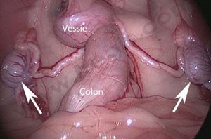 1. Laparoscopie (ou coelioscopie) sur un chien de race Yorkshire terrier cryptorchide. Cette technique chirurgicale permet de visualiser les deux testicules restés dans l’abdomen (flèches) puis de les retirer par une toute petite incision