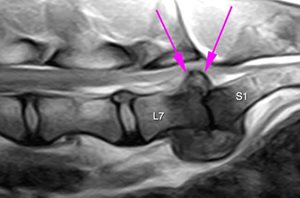 IRM d’un chien atteint d’un syndrome QDC avec hernie et dégénérescence