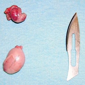 Ectopie testiculaire — Wikipédia