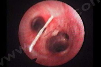 Image endoscopique de bronches : on observe la présence d’un flocon et d’une bride de matériel muco-purulent, ainsi qu’une muqueuse enflammée.