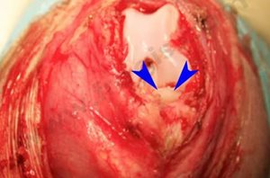 1. Photographie per-opératoire du genou d’un chien American Staffordshire Terrier de 6 mois atteint d’une ostéochondrite disséquante.