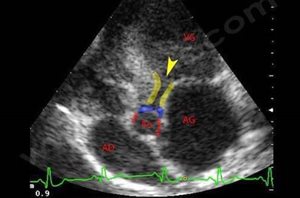 2. Photo 3 : Echocardiographie d’un chien Berger allemand atteint de sténose aortique. Le sang venant du ventricule gauche (VG) a du mal à passer vers l’aorte (Ao), à cause d’un véritable tunnel fibreux très étroit (délimité par les traits jaunes). L’oreillette gauche (AG) est très dilatée par rapport à la droite (AD). En bleu, la valve aortique