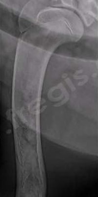 Radiographie de l’humérus d’un jeune chien en croissance avec des lésions caractéristiques d’une panostéite en phase tardive avec une résorption partielle de la lésion
