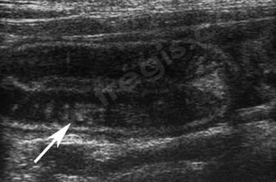 Echographie abdominale d’un chien atteint d’une lymphangiectasie. La paroi de l’intestin grêle présente un aspect strié anormal. Le diagnostic final se fera à partir de biopsies intestinales réalisées grâce à une fibroscopie digestive.