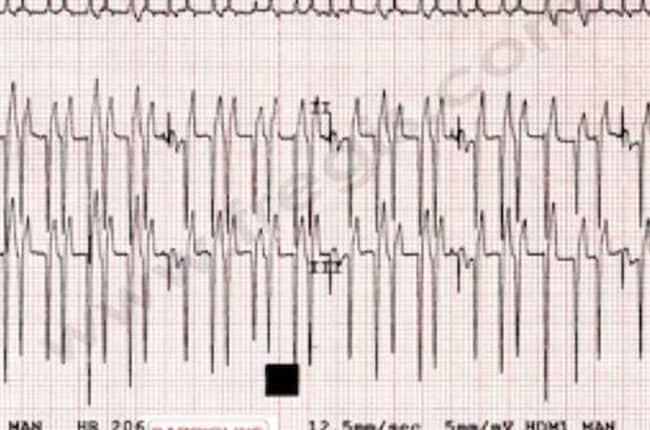 Insuffisance cardiaque chez le chien