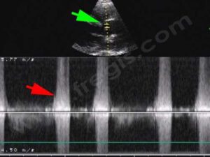 Akita Inu, echographie communication interventriculaire