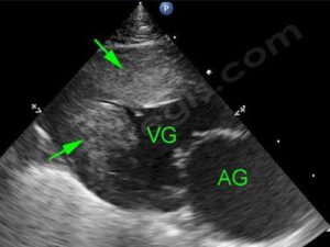 Myocardiopathie hypertrophique chez le Persan