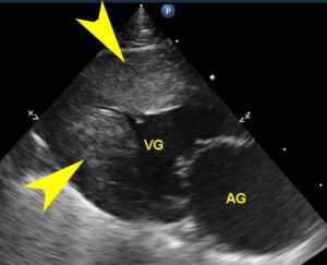 Cardiomyopathie hypertrophique ou Myocardiopathie hypertrophique (CMH ou HCM) chez le Mau égyptien