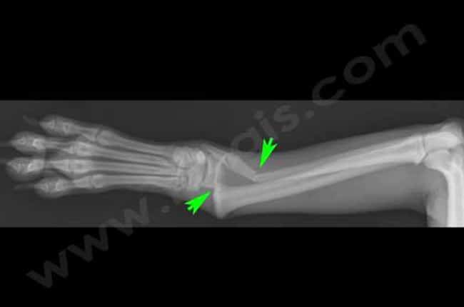 Fractures pédiatriques (ou fractures de type Salter Harris) chez le chien