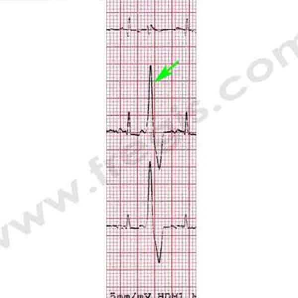 Cardiomyopathie arythmogène du ventricule droit ou ARVC chez le chien