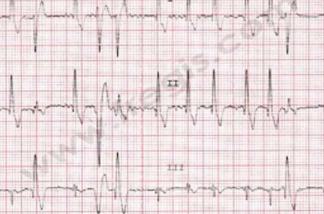 Cardiomyopathie dilatée (CMD) chez le chien et le chat